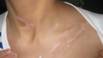 锁骨下边的皮肤白一块是怎么了