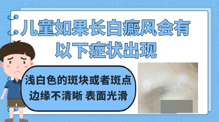 儿童如果长白癜风会有哪些症状出现