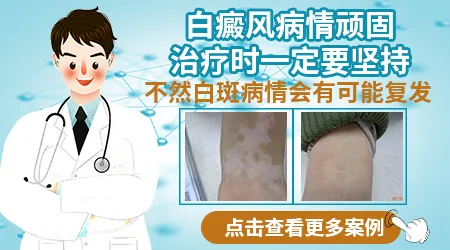 额头上长白癜风用什么药能去除