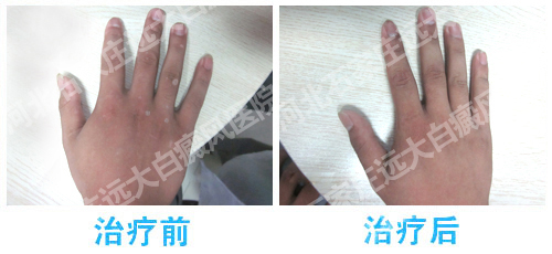 手指关节白斑是怎么引起的