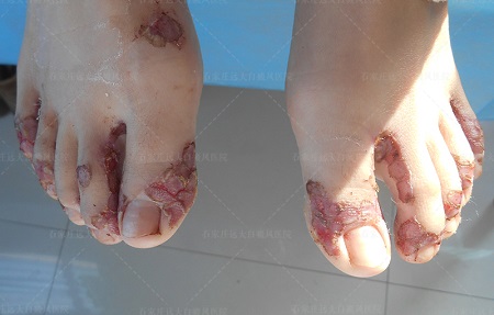 肢端型白癜风能做植皮手术吗