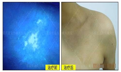 白癜风照光仪器哪个牌子比较好