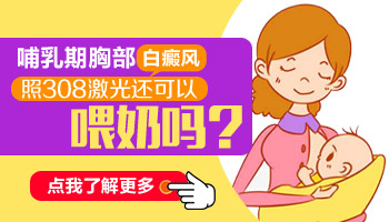 哺乳期白癜风扩散了怎么办