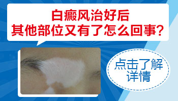 白癜风植皮过后别的地方又长了
