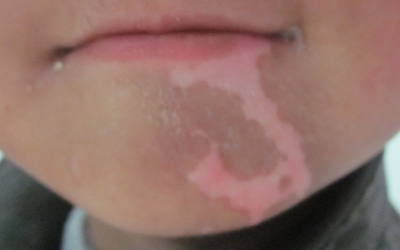婴儿嘴周围皮肤是白色的怎么回事