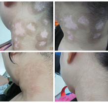 白癜风常用药物都有什么