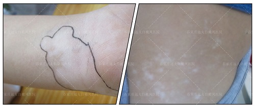 白癜风复发有什么特点