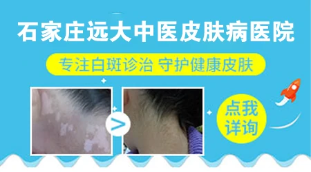 石家庄治疗皮肤白斑的医院