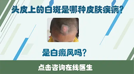 男性头皮上出现一块白怎么回事