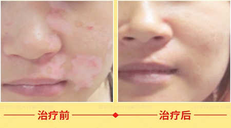 白癜风抗复发治疗春季可以吃药吗