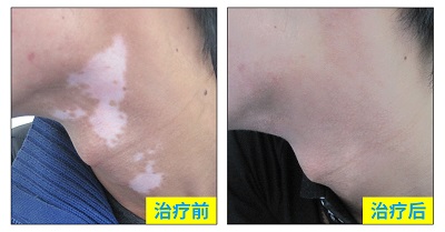 白癜风恢复图片对比