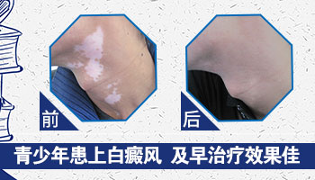 邢台治疗青少年白癜风哪家好