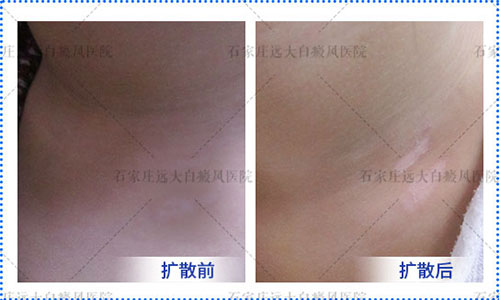 白斑做一次308激光费用