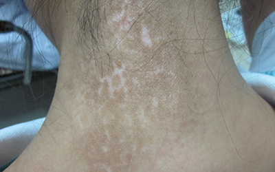 脖子后面长密密麻麻的白斑是什么