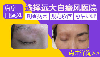 山西阳泉治疗白癜风ZUI好的医院