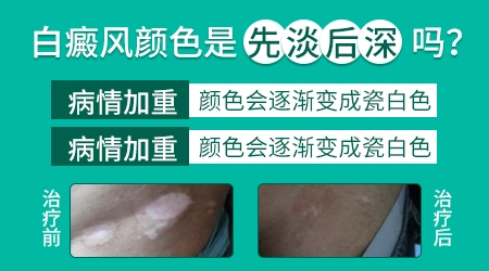 白癜风刚长出来时是纯白色吗 早期颜色变化全过程