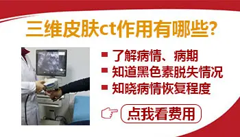 可以自己买伍德灯检查白点吗