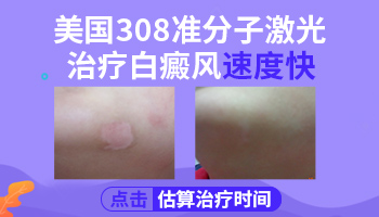 家用308准分子激光治疗白癜风效果图