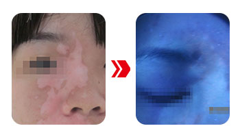 白斑在伍德灯下是弱阳性代表什么