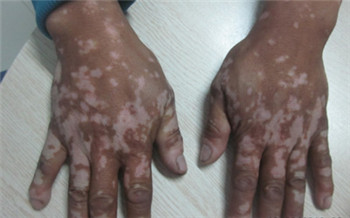 手背白斑初期症状图片