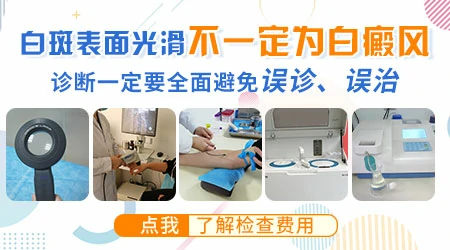 白癜风初期容易被误诊吗
