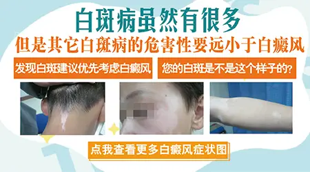 白癜风和贫血痣早期症状图