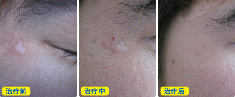 保定白癜风治疗医院哪家好