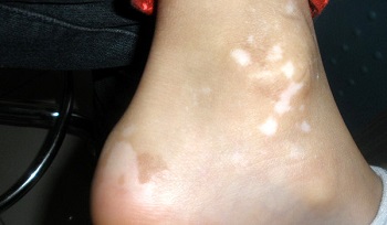 怎样区别白斑 早期白癜风长什么样