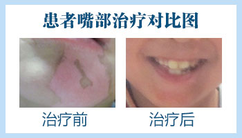 唇部白癜风做完多久能恢复