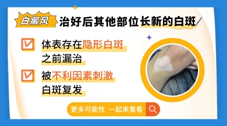白癜风治疗过程中出现新白斑正常吗