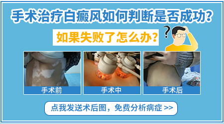 白斑移植一个月了还是红是不是移植失败