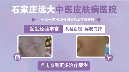 石家庄哪个医院的皮肤科看白斑口碑好