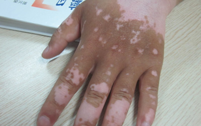 手关节处颜色发白是怎么了