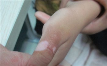 手指上出了好多小白点点是什么