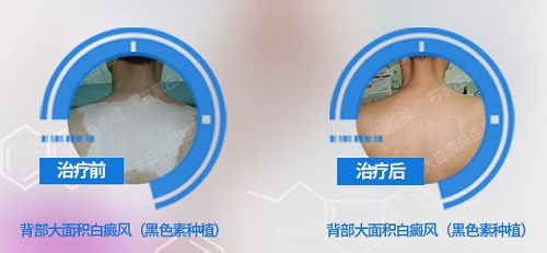 白癜风黑色素移植成功的症状图片