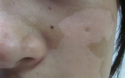 脸蛋上的皮肤比其他地方白一些怎么回事