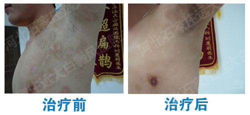 白癜风的家用治疗仪可信吗 哪个牌子是真的