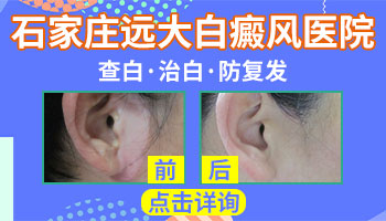 白癜风复色后还要照308吗