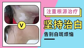 白癜风医院什么办法治白癜风好