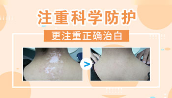 白癜风治愈后能做双眼皮手术吗