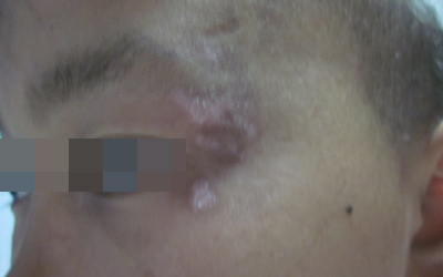 眼睛旁边长白斑是什么原因造成的