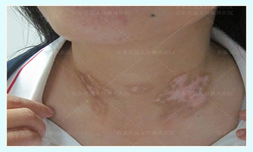 脖子上长白斑图片图库