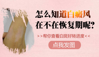 白癜风有的在恢复有的在发展