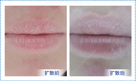 口唇白斑初期症状图片