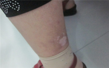 白斑发现两个月了是不是白癜风