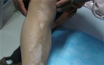 小儿腿上白斑最初期的图片