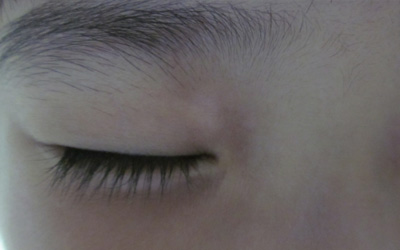 眼角处出现一个白点是不是白癜风