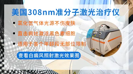 308激光照白癜风一般照几次能看到明显效果