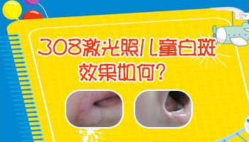 5岁小朋友有白癜风用激光治疗吗