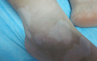 脚面白癜风有一个多月了